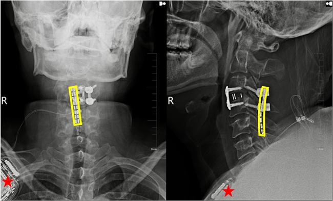 植入術后X線顯示，黃色方框為電極位置，星號為皮下脈沖發射器位置。