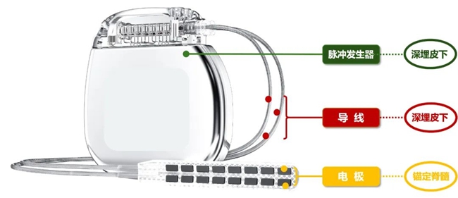 脊髓電刺激器植入部分示意圖。